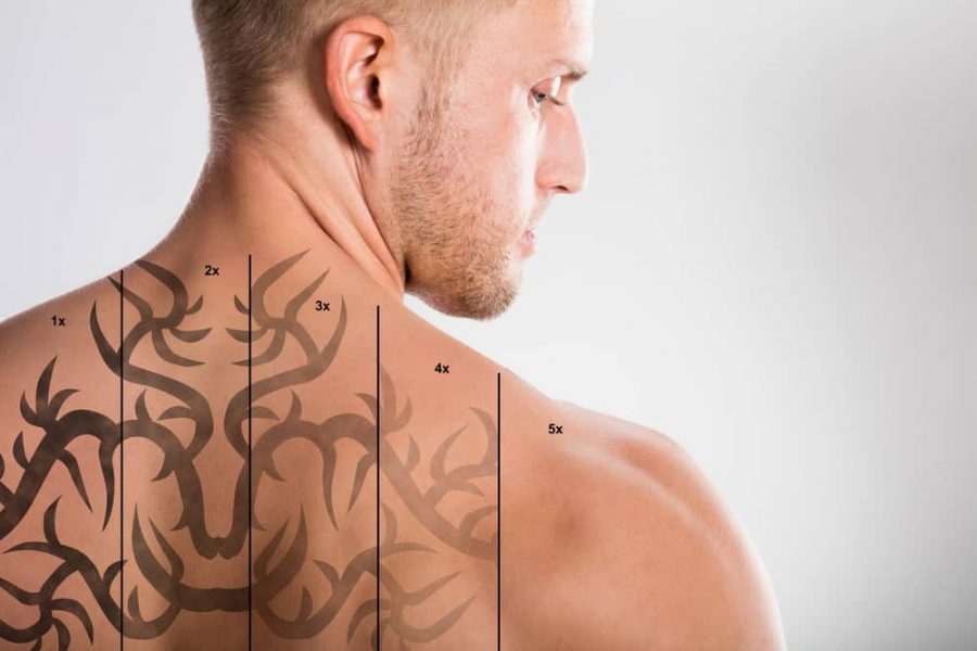 Man with gradual laser tattoo removal