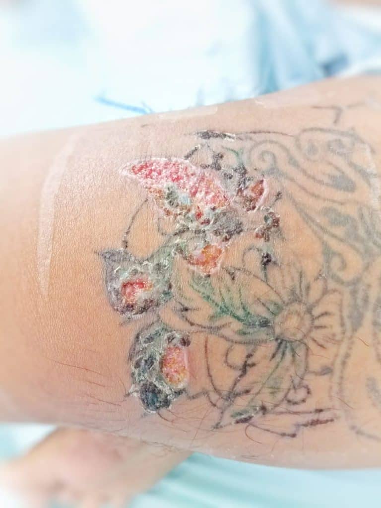 Poorly Healed Tattoo After Infection Scabbed And Faded