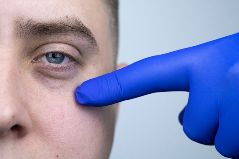 Reasons to Avoid Vitamin K – How To Get Rid Of Dark Circles Under Eyes For Men