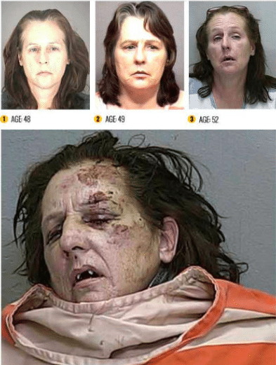 before and after meth pictures
