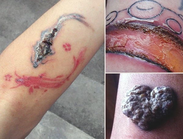 How To Tell If A Tattoo Is Infected Signs And Symptoms