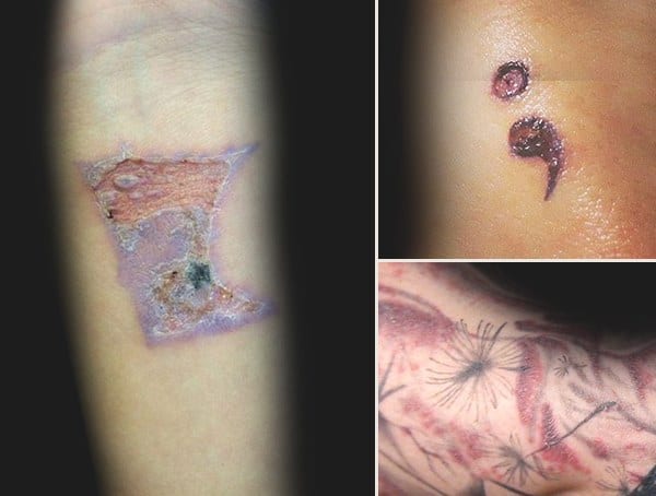 Infected Tattoo Symptoms On Skin