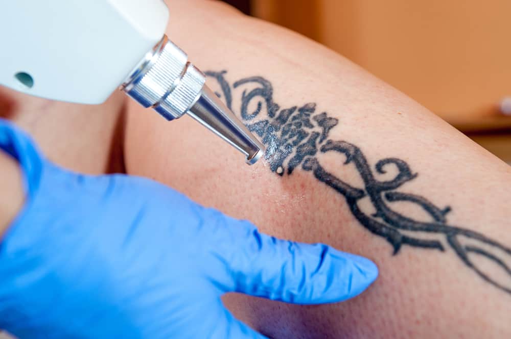 enlèvement de tatouage au laser de la jambe
