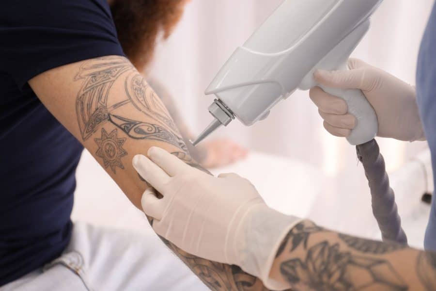 Laser Tattoo Removal Of Tattoo