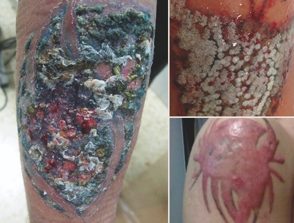 Skin Symptoms Of Infected Tattoos