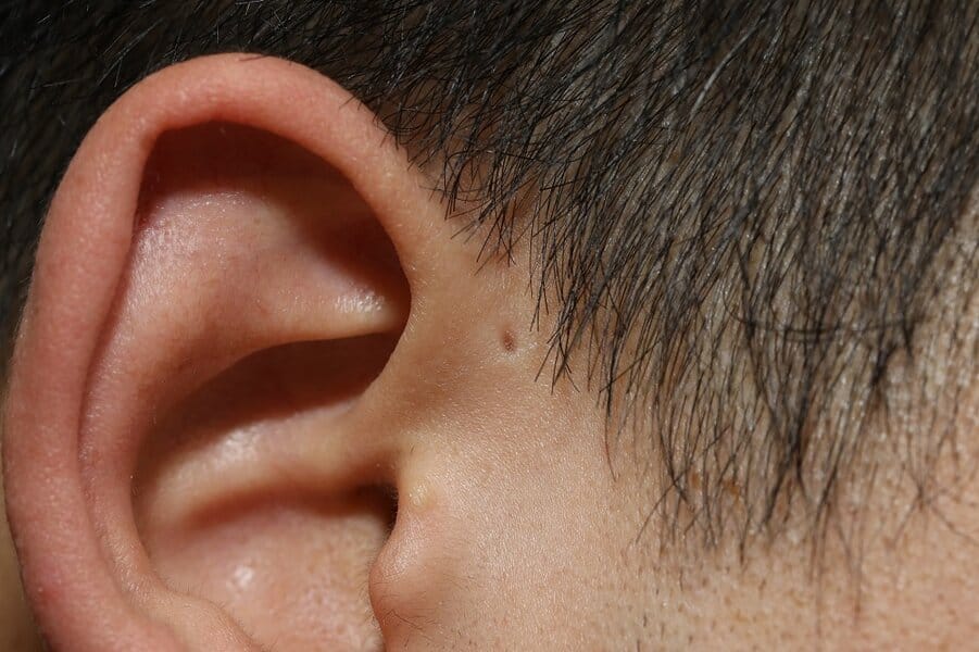 small hole on human external ear