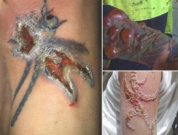 What Does An Infected Tattoo Look Like Images